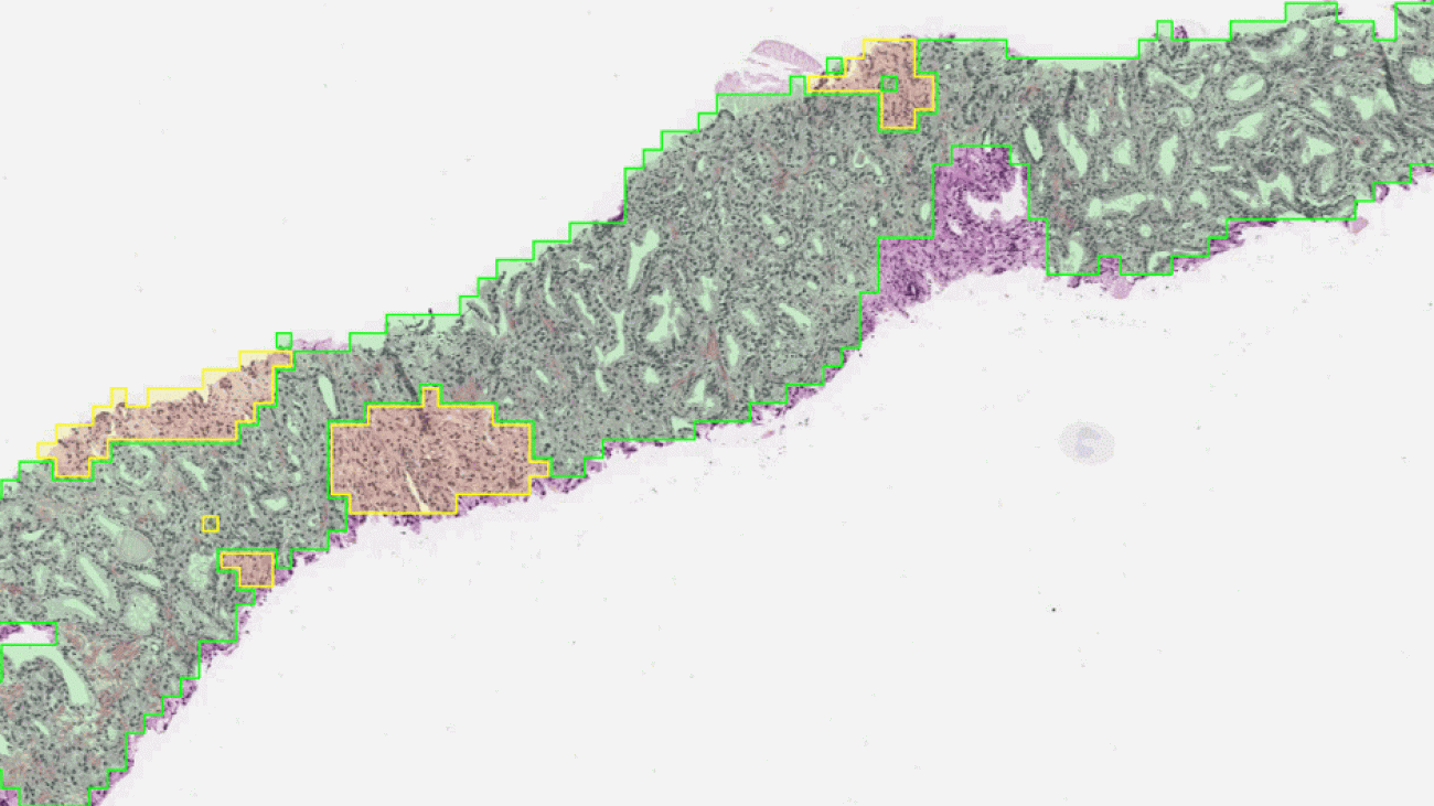 Using AI to identify the aggressiveness of prostate cancer