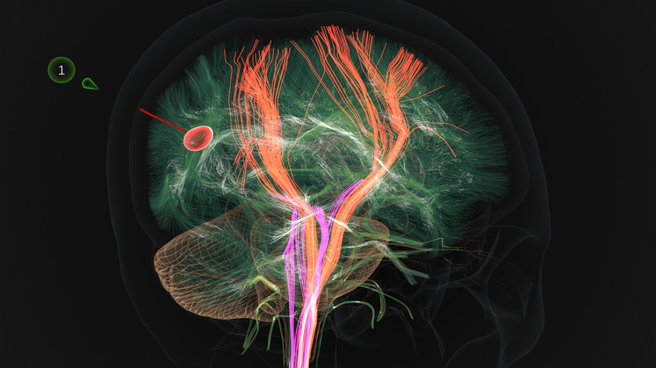 Brains of the Operation: Atlas Meditech Maps Future of Surgery With AI, Digital Twins